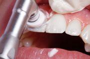 Eine schonende Politur schützt Zahn und Zahnfleisch